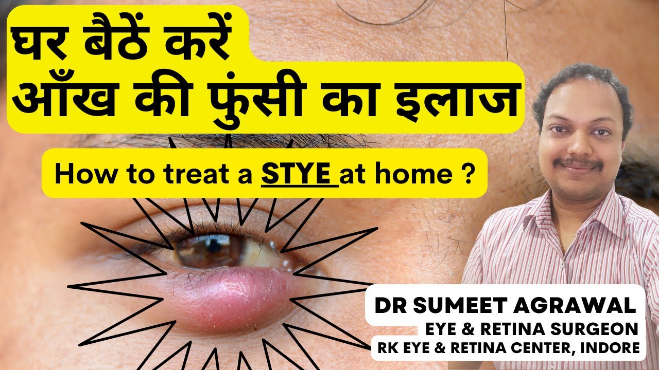 How to treat a STYE at home ?  घर पर करें आँख की फुंसी का इलाज l