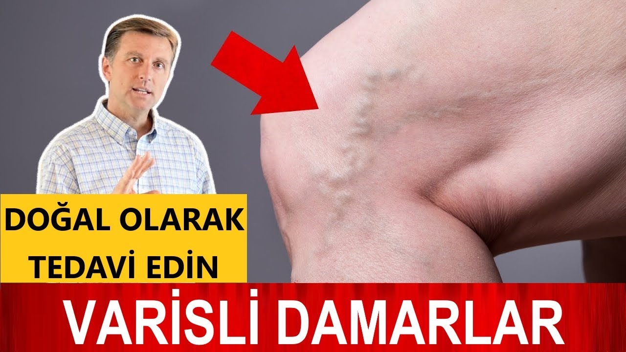 Varisli Damarlar Doğal Olarak Nasıl Tedavi Edilir? Dr.Berg Turkçe