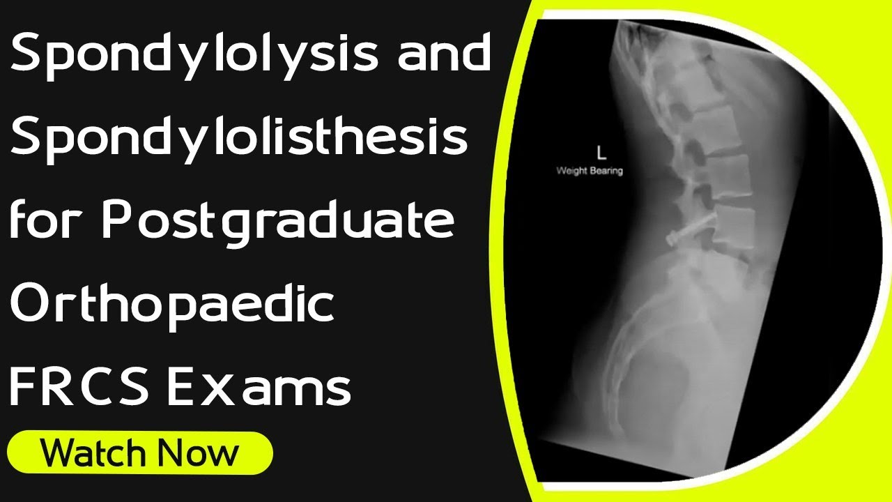 Spondylolysis and Spondylolisthesis for Postgraduate Orthopaedic FRCS Exams | Orthopaedic