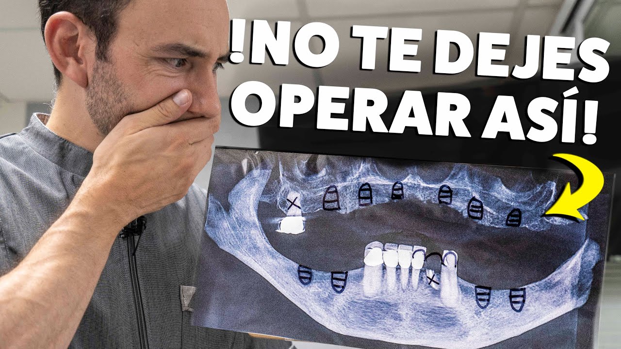 NO TE PONGAS IMPLANTES DENTALES sin una TOMOGRAFÍA | La Panorámica NO es suficiente.