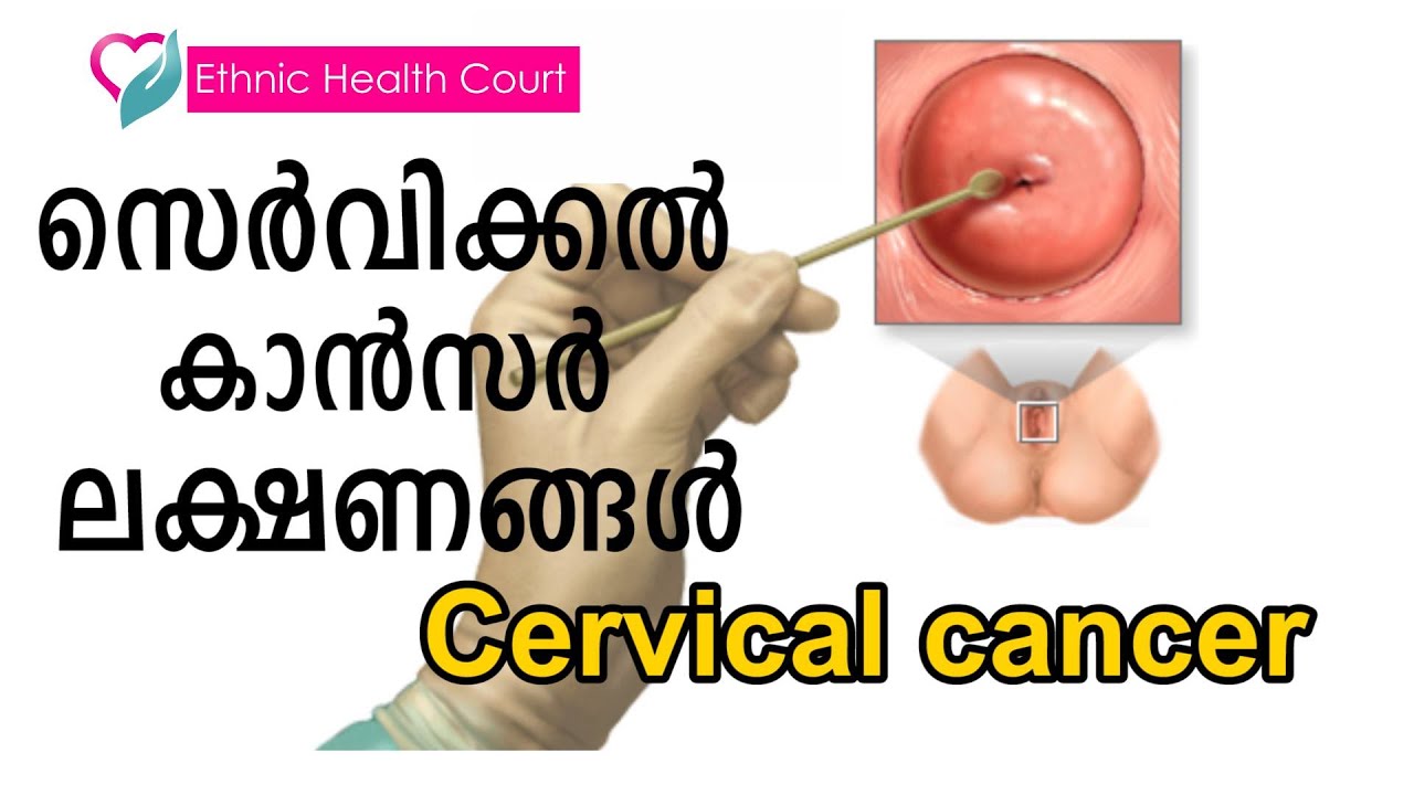 സെർവിക്കൽ കാൻസർ | അറിഞ്ഞിരിക്കണം ഈ ലക്ഷണങ്ങൾ. l Cervical cancer | Ethnic Health Court
