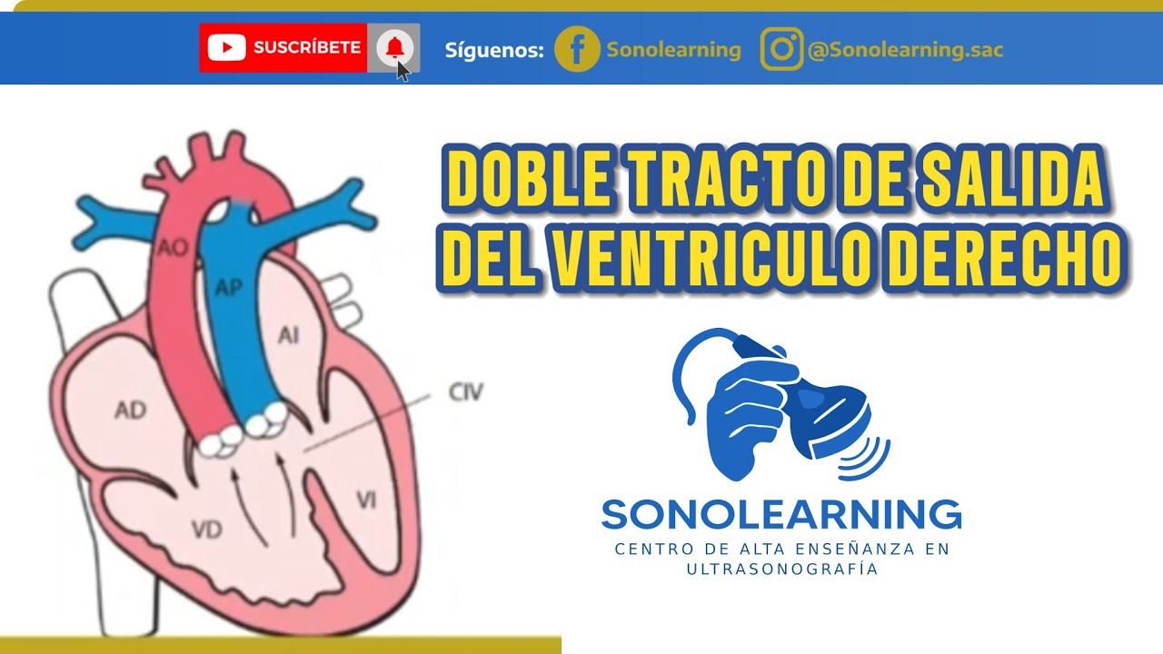DOBLE TRACTO DE SALIDA DEL VENTRICULO DERECHO