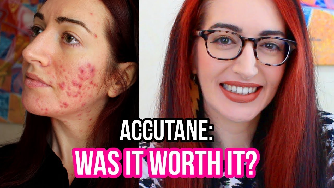 My FINAL Accutane Update (I hope...) Results: What's Good & What's BAD!