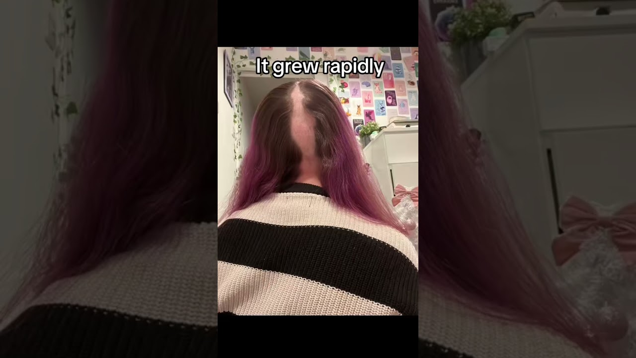 My hair loss journey #alopecia