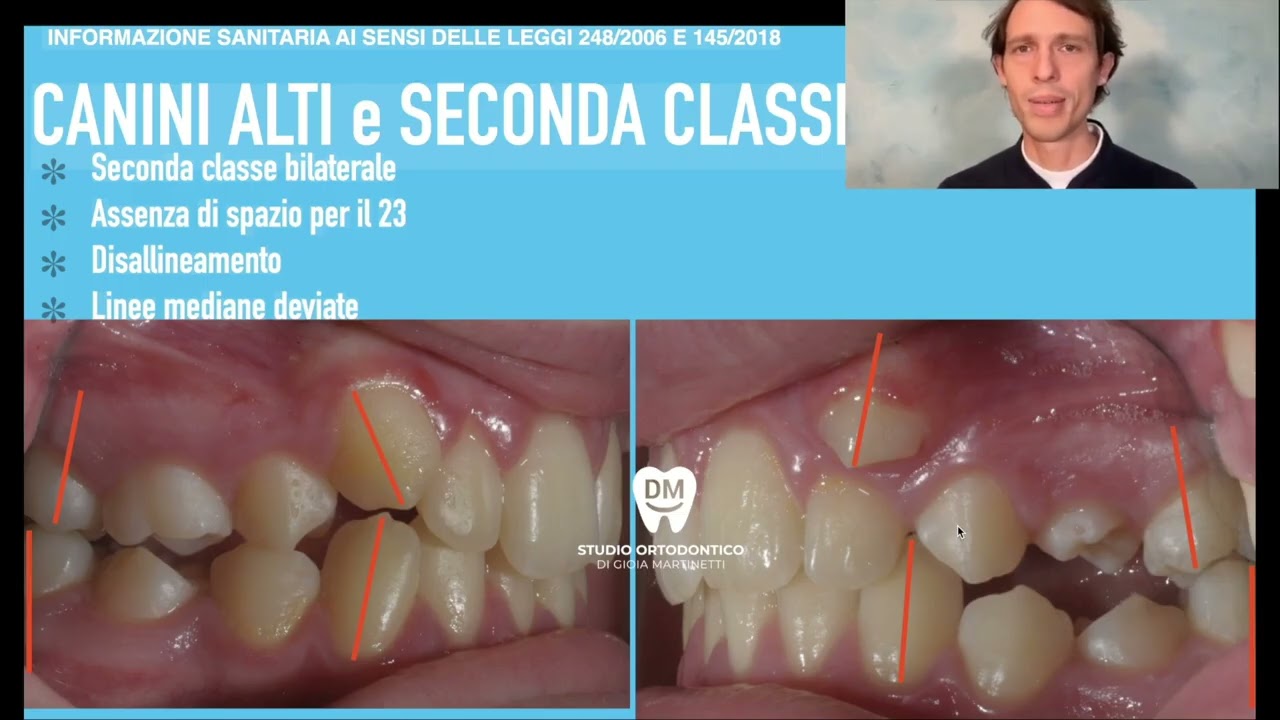 🇬🇧Clear Aligners for Class II Malocclusion: High Canine Before and After