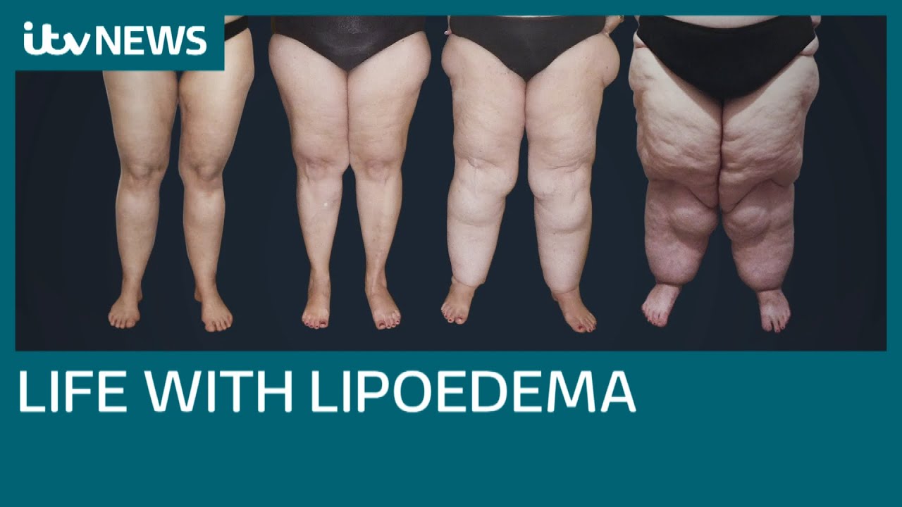 Campaigners call for more help on the NHS for painful Lipoedema | ITV News