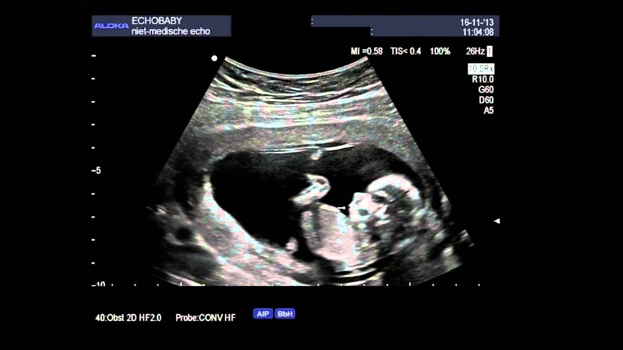 2D echo van een bewegend meisje van 13 weken dat ook drinkt