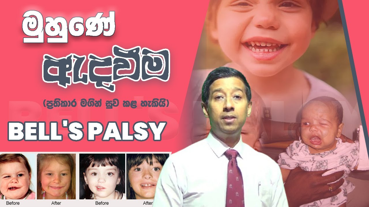 මුහුණේ ඇදවීම Bell's Palsy (ප්‍රතිකාර මගින් සුව කළ හැකියි)