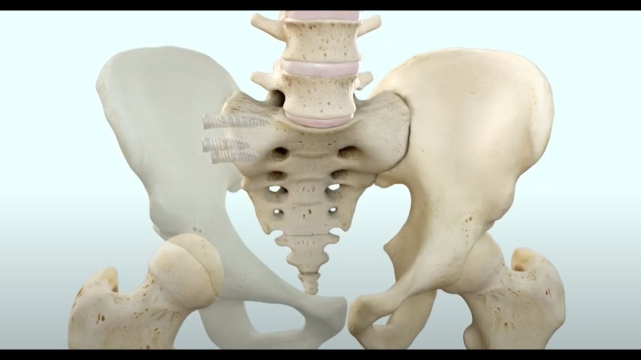 SI Joint Dysfunction and iFuse TORQ® Implant Animation (Full version)