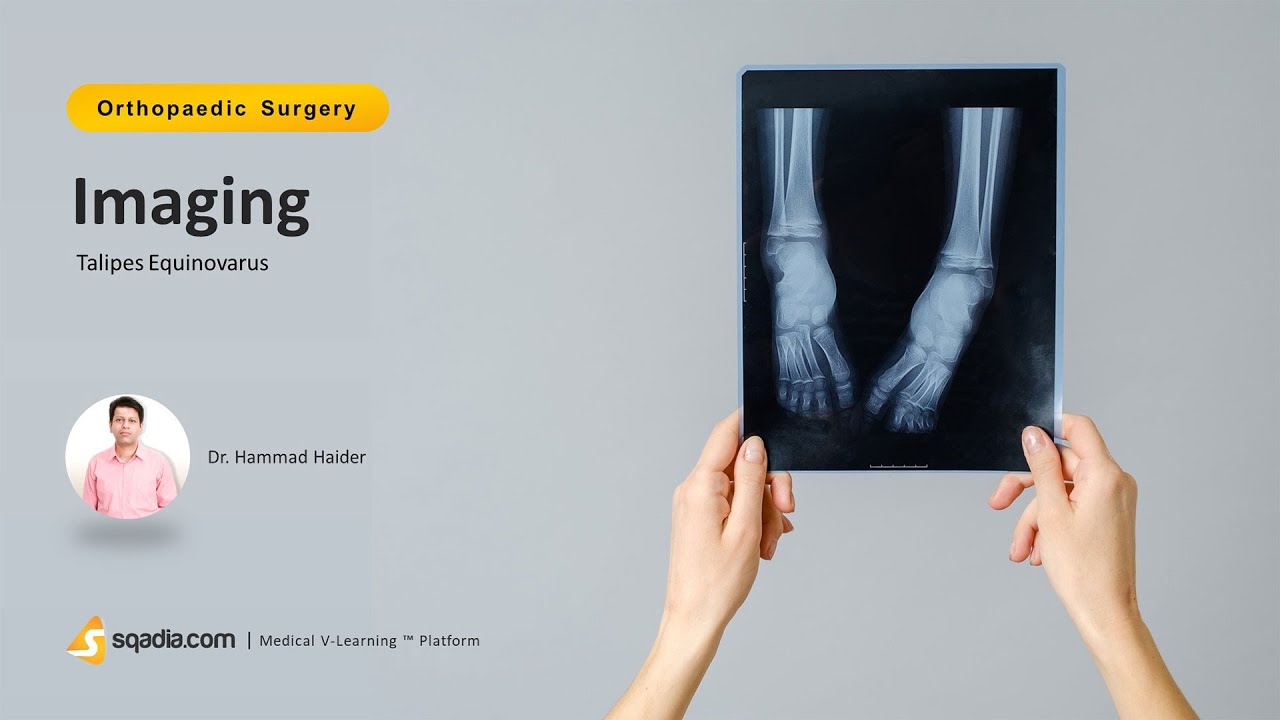 Talipes Equinovarus | Imaging