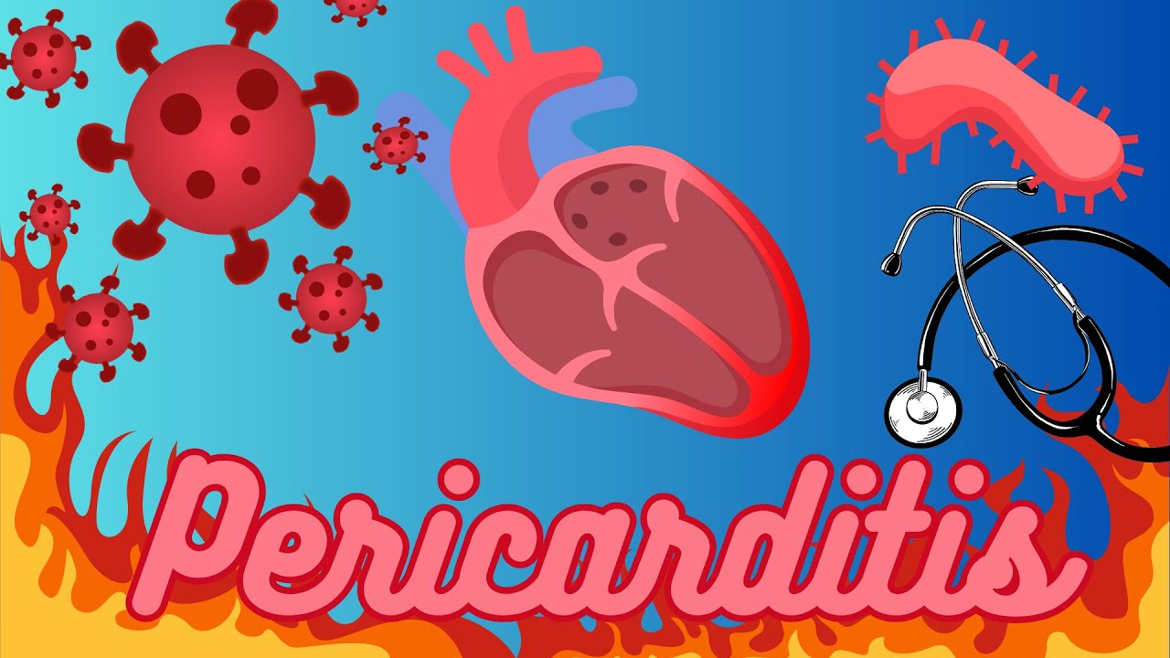 PERICARDITIS AGUDA