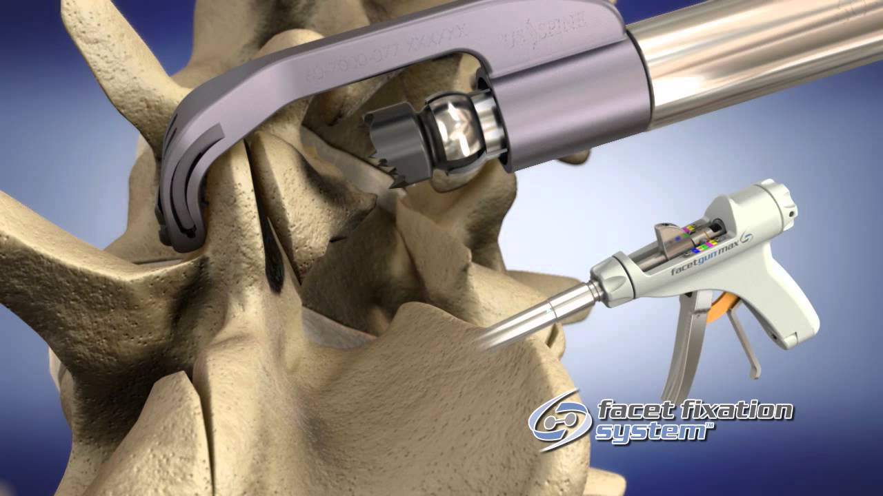 The FacetGun Max Facet Fixation System