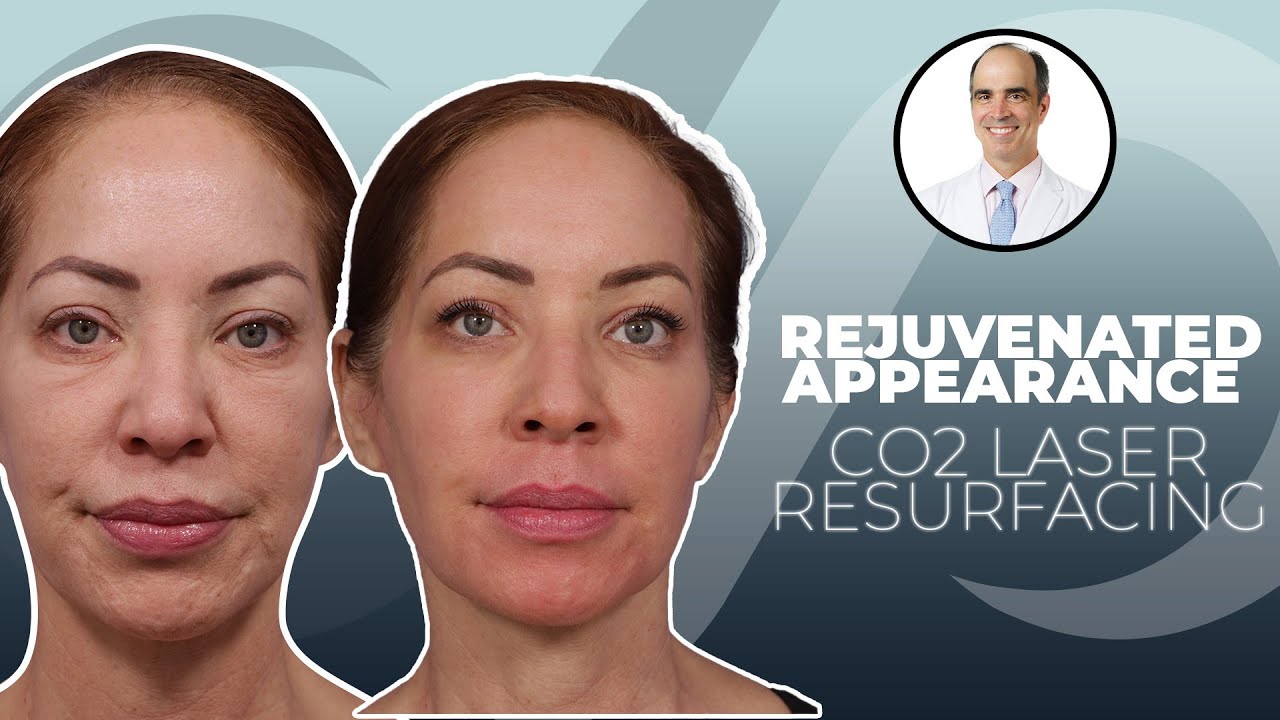 CO2 Laser Resurfacing for a Beautiful and Smooth Skin | Dr. Stoker