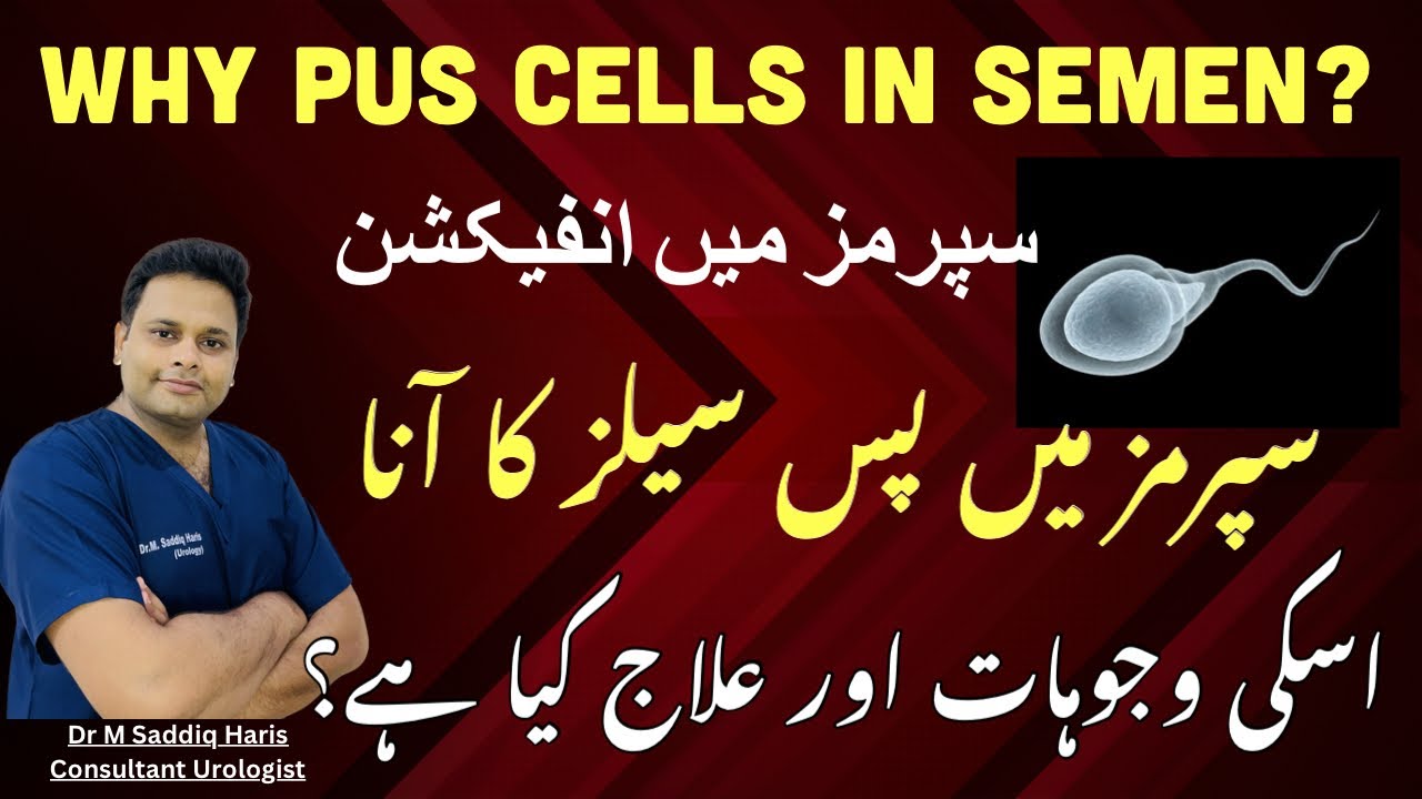 Puss Cells in Semen || Infection in Semen || Causes and Treatment Explained by Expert Urologist