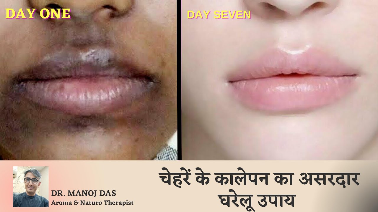 होठों के आसपास का कालापन कैसे दूर करें I How To Remove Dark Spots Around Mouth | DR. MANOJ DAS