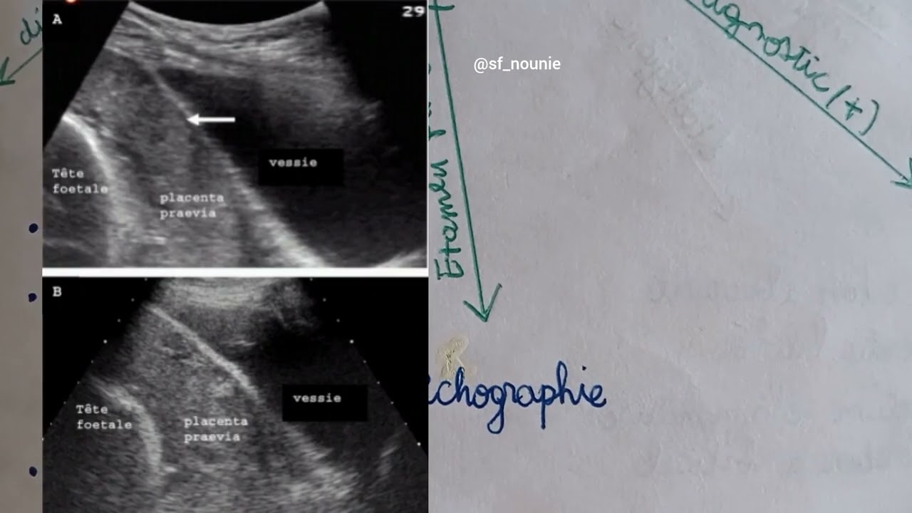 Obstétrique path : placenta preavia 😣💥