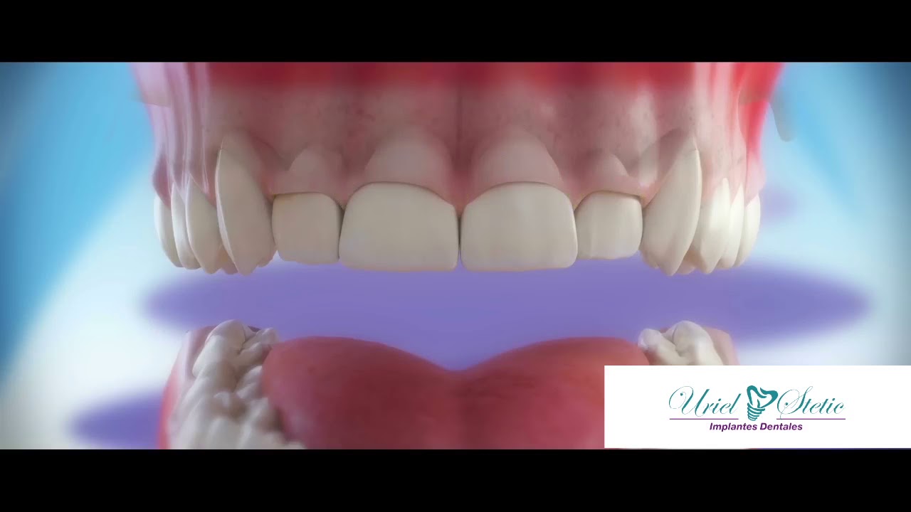Gingivoplastia