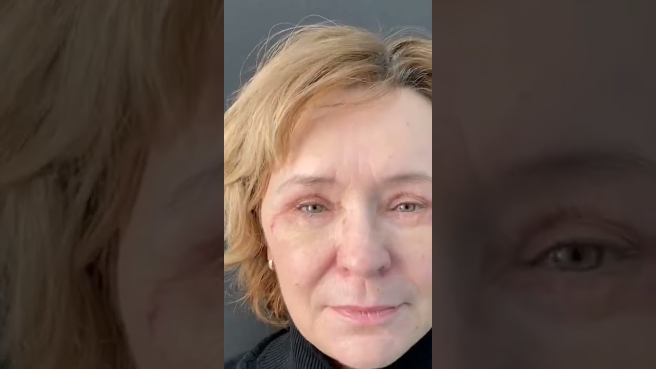 До и после верхней и нижней блефаропластики ( прошло всего 7 дней после операции) ⛔ Есть отёки.