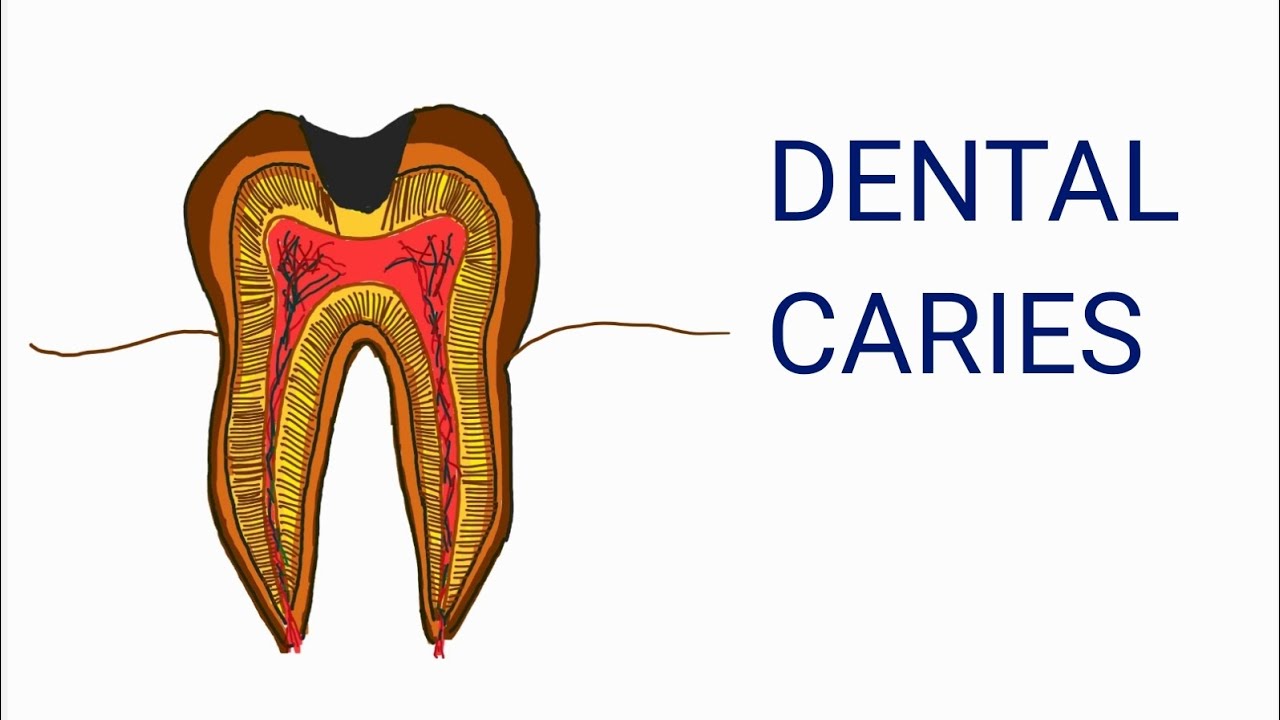 DENTAL CARIES( Miller's chemicoparasitic theory)