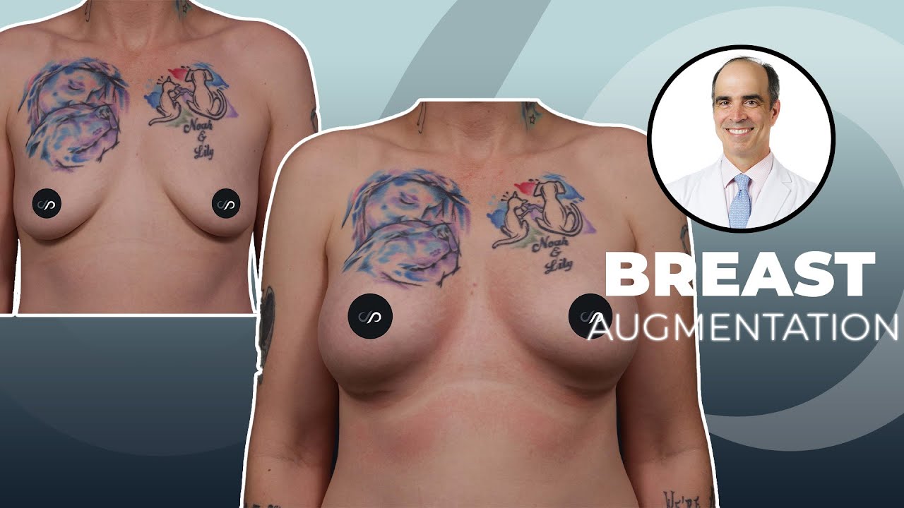 Breast Augmentation Result: What To Expect | Dr. David Stoker