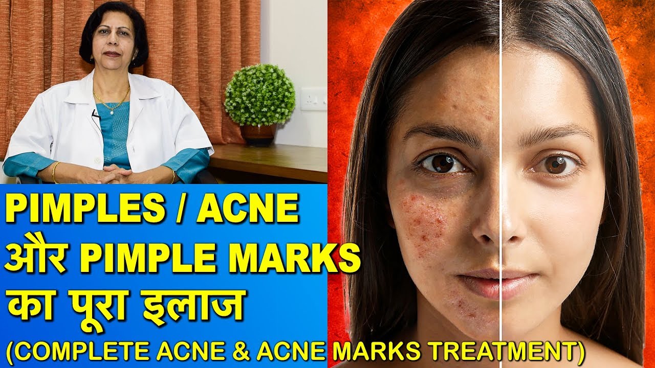Pimples/Acne और Pimple Marks का पूरा इलाज || Complete Treatment of Acne & Acne Marks