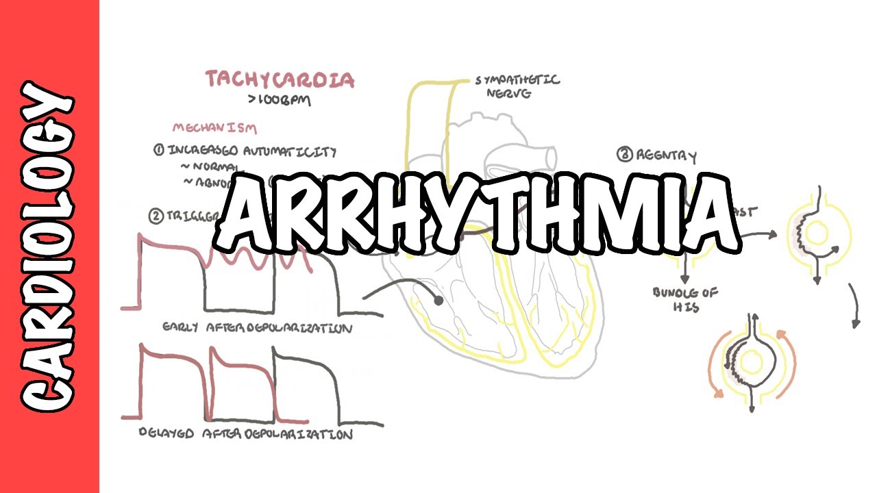 Arrhythmia Overview - Mechanism of bradyarrhythmia and tachyarrhythmia