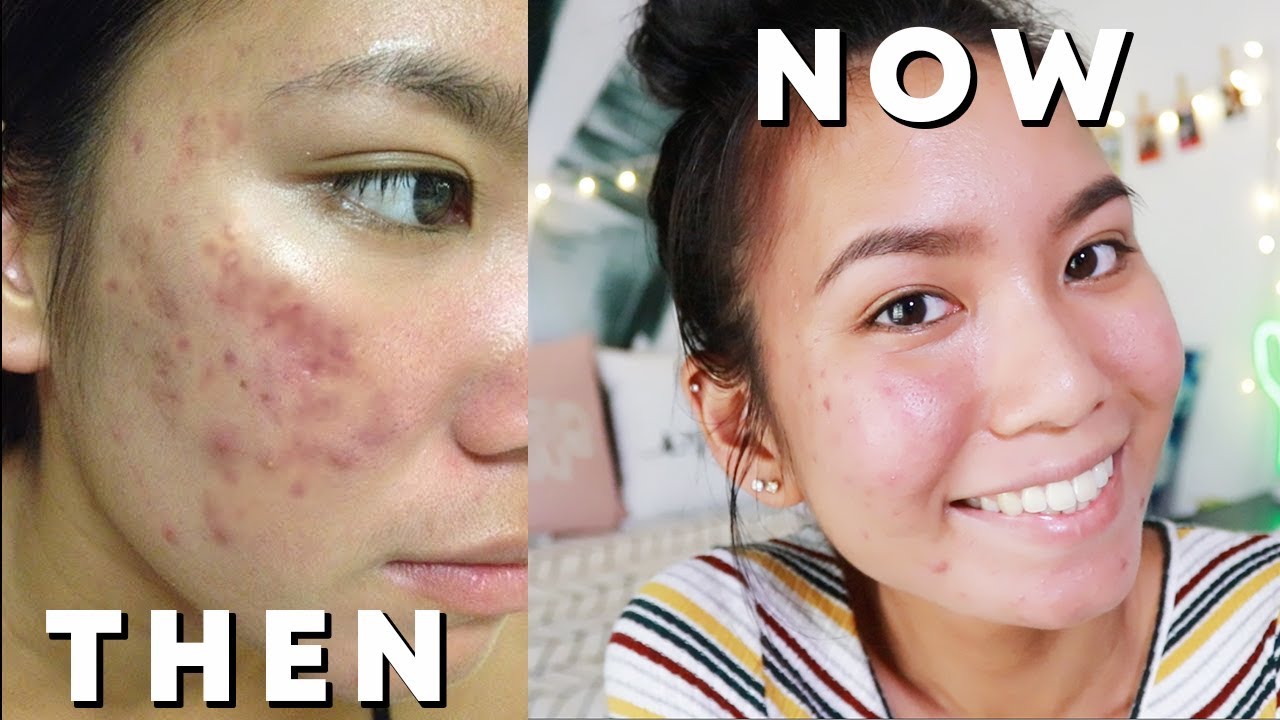 Acne Update: 1 Year on Spiro, Birth Control, & Skincare Routine