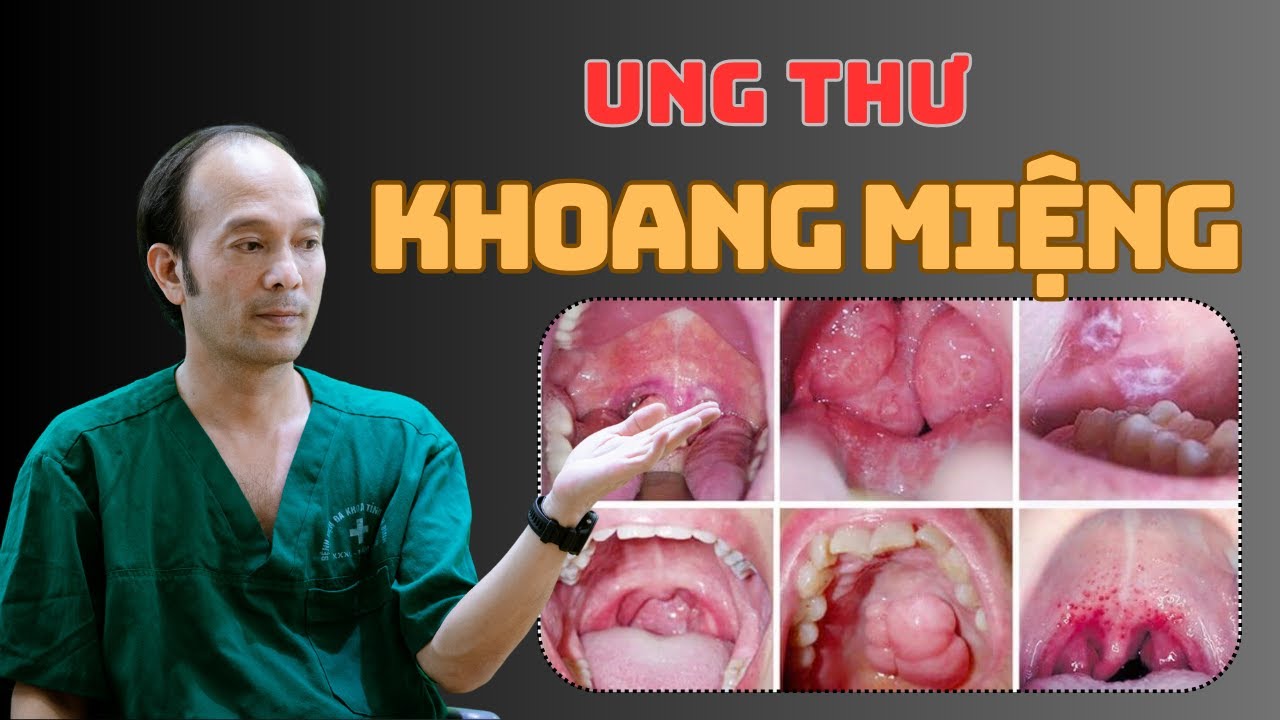 Dấu Hiệu Nhận Biết Ung Thư Khoang Miệng - Số 151 | Dr Phùng Khoa