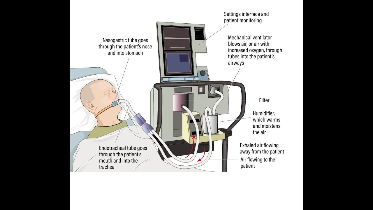 Ventilator Associated Pneumonia VAP الالتهاب الرئوي المصاحب المصاحب لجهاز التنفس الصناعي