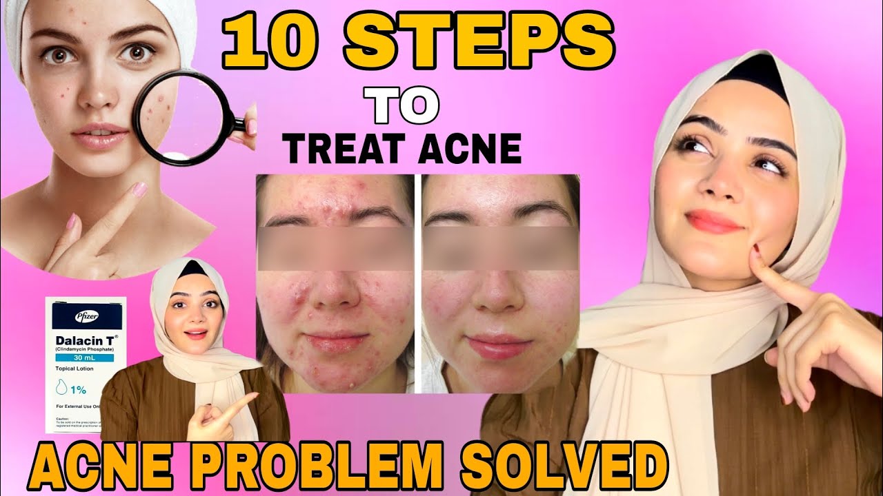 10 Basic Steps To Treat Acne | Acne Treatment At Home | Dietitian Aqsa