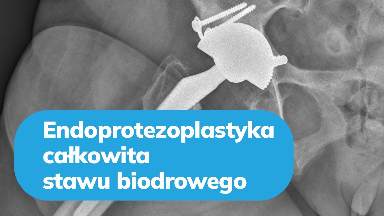 Endoprotezoplastyka całkowita stawu biodrowego - dr hab. n. med. Ireneusz Babiak