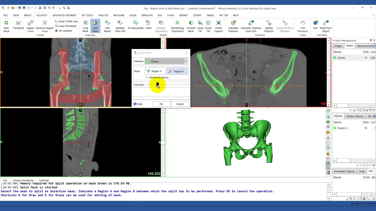 How to Use the Split Mask Tool in Mimics | Mimics Innovation Suite | Materialise Medical