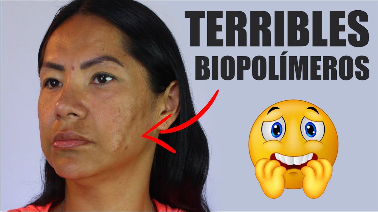 RETIRO de BIOPOLIMEROS de la Cara 💉 Cirugía Reconstructiva 💔 Aceite de Avión 🔴 Dr ALBERTO CALVO