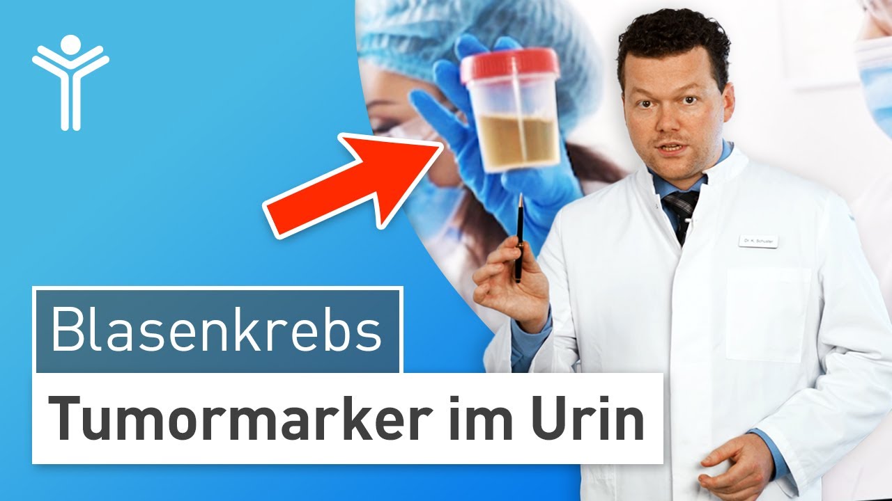 Urin-Schnelltest: Blasenkrebs durch Tumormarker erkennen