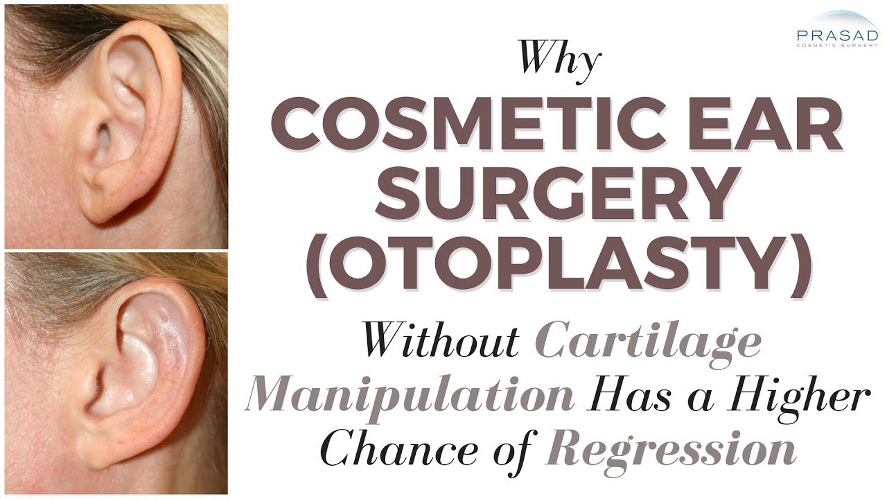 Why Manipulation of Cartilage is Important in Cosmetic Ear Surgery (Otoplasty) to Reduce Regression