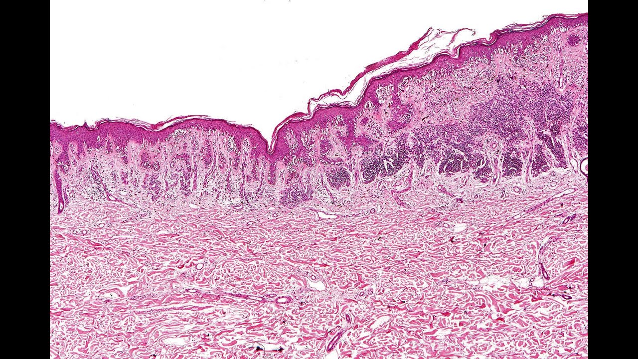back to basics lecture #3 The enigmatic dysplastic nevus Phillip H McKee  HD 720p