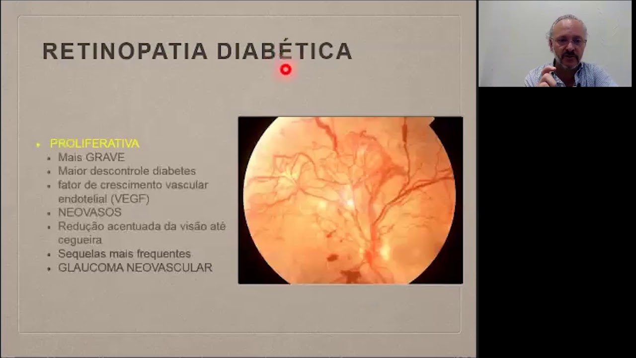 Retinopatia Diabética