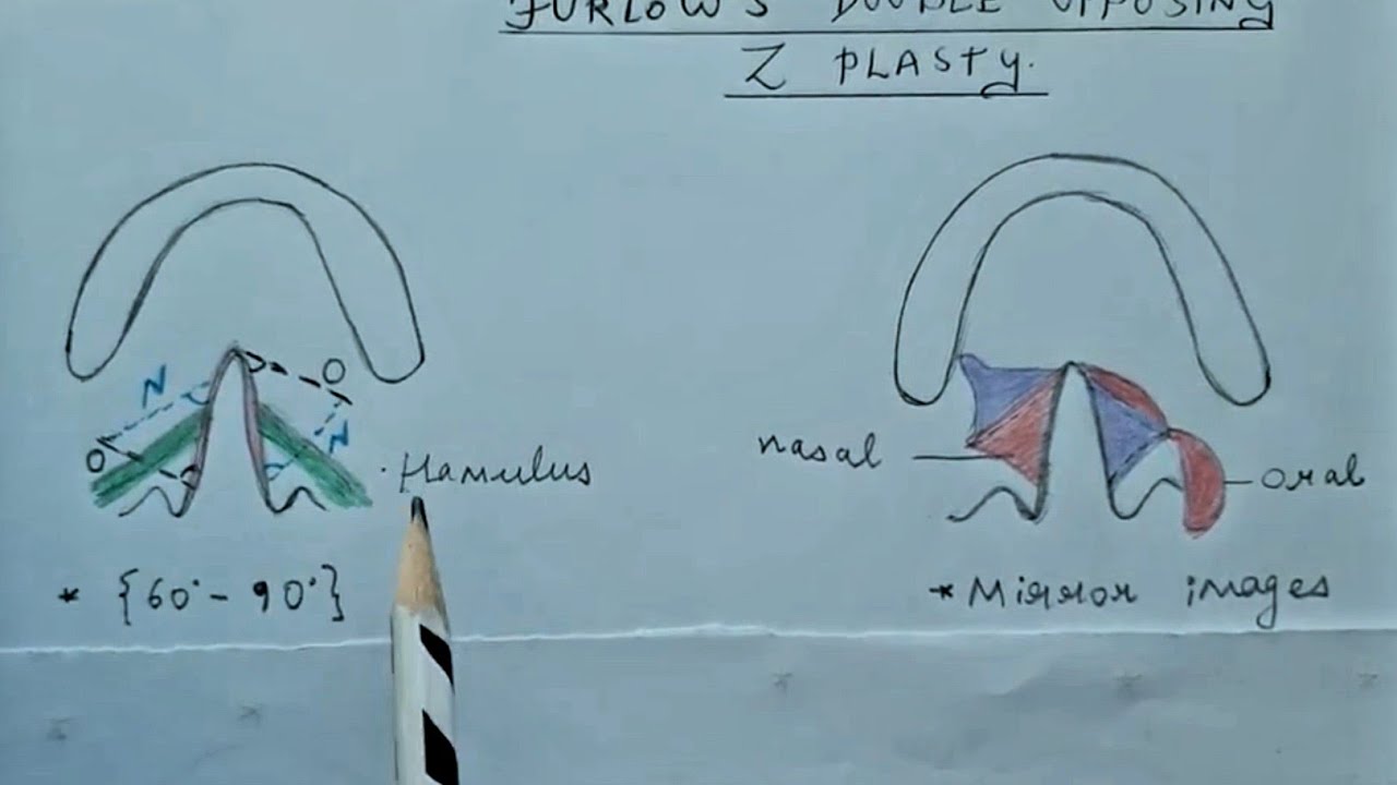 Furlows double opposing Z plasty