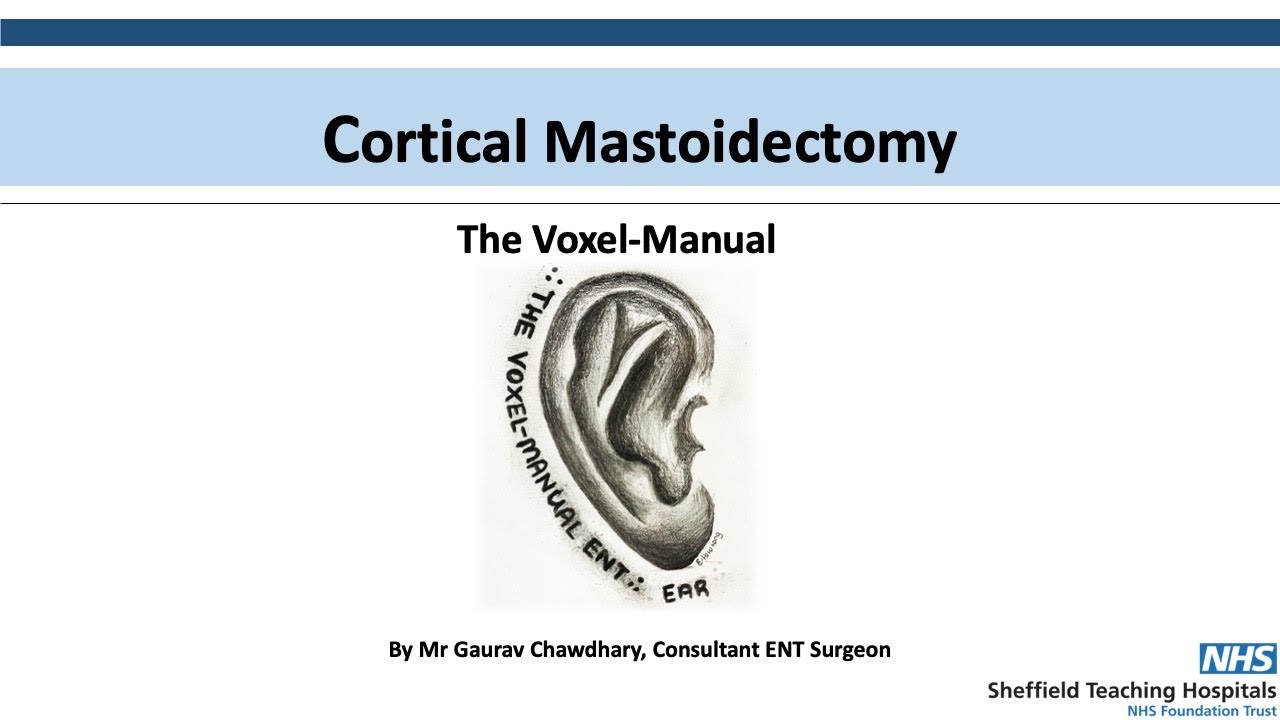 Cortical Mastoidectomy