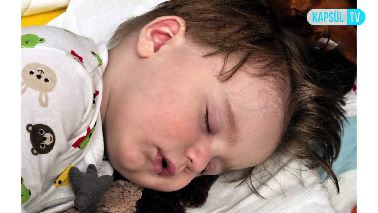 Spina Bifida Belirtileri Nelerdir?