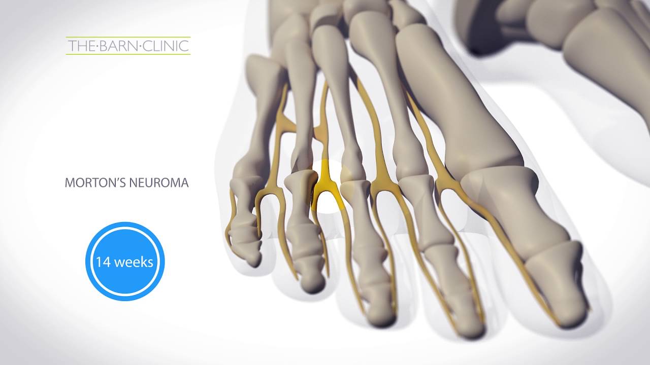 Cryosurgery for Morton's Neuroma @ The Barn Clinic, Sheffield & London