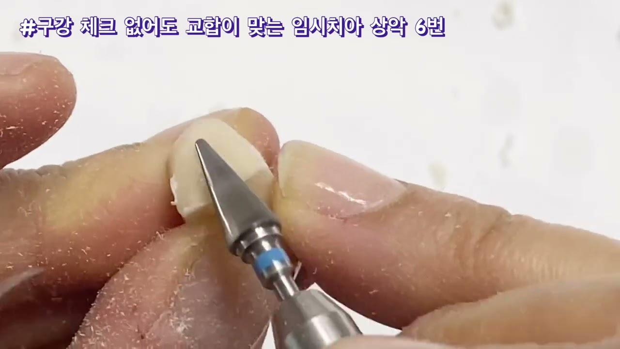 구강내 체크없이 교합이 맞는 임시치아 조각해봤어요 temporary sculpt without intraoral check
