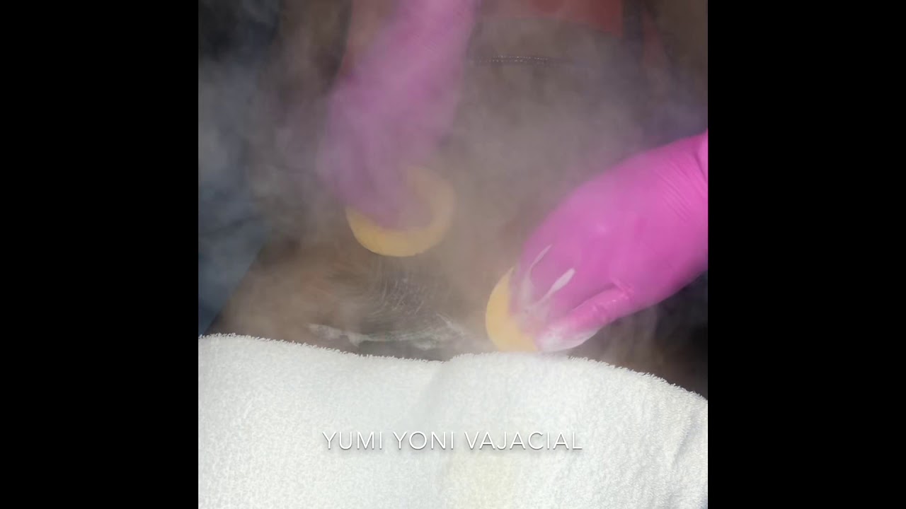 Vajacial Treatment