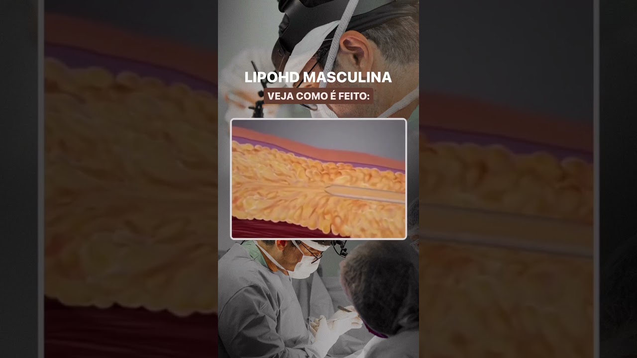Voc&ecirc; conhece a cirurgia Lipo HD masculina? #cirurgiaplastica