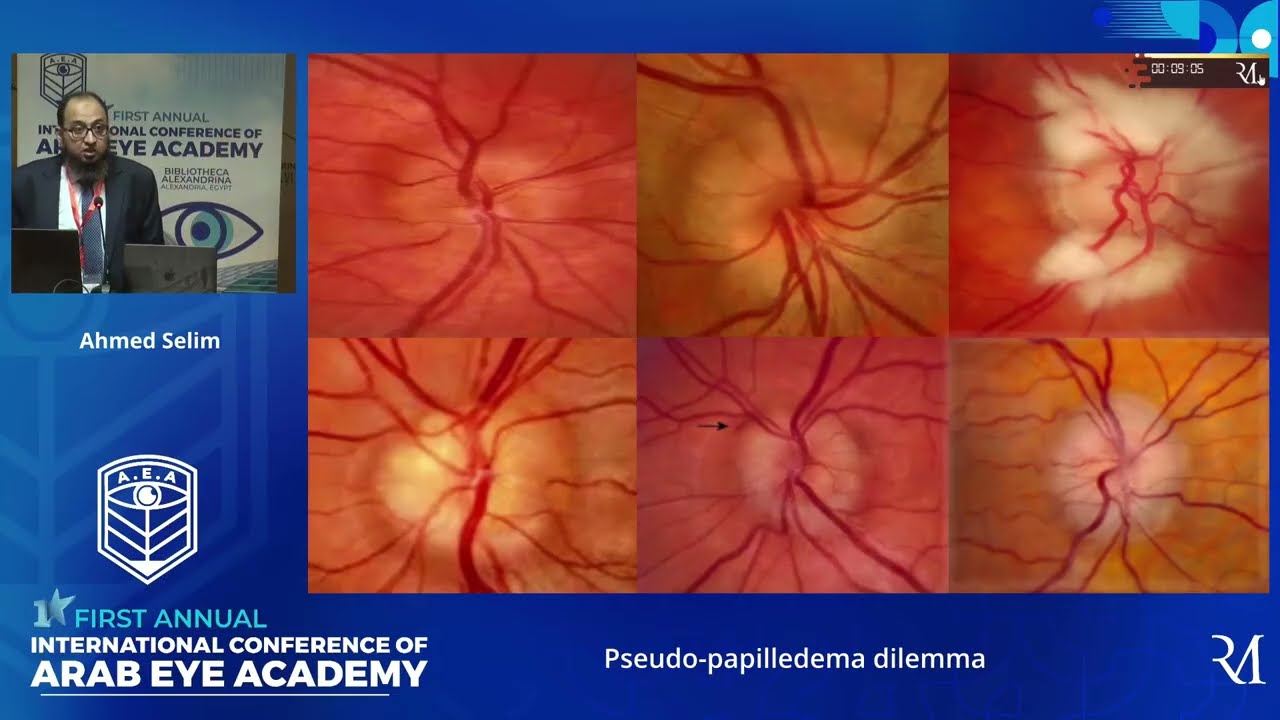 Pseudo-papilledema dilemma, Dr. Ahmed Selim