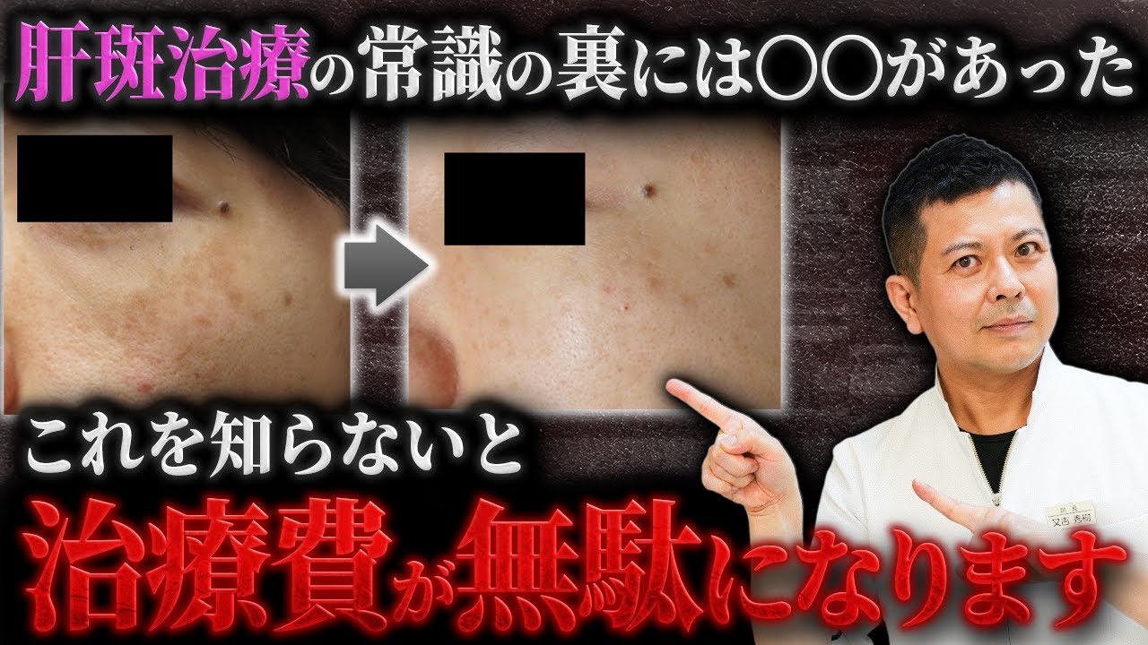 シミ•肝斑を本気で治したい方は必ず見てください。肝斑の原因と正しい治療法を美容外科歴20年の又吉が徹底解説します。