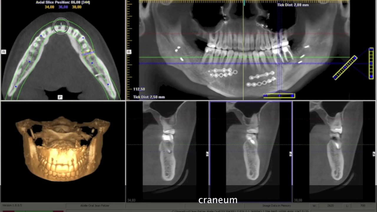 I-cat Vision, o que voce pode fazer com ele. CRANEUM Radiologia