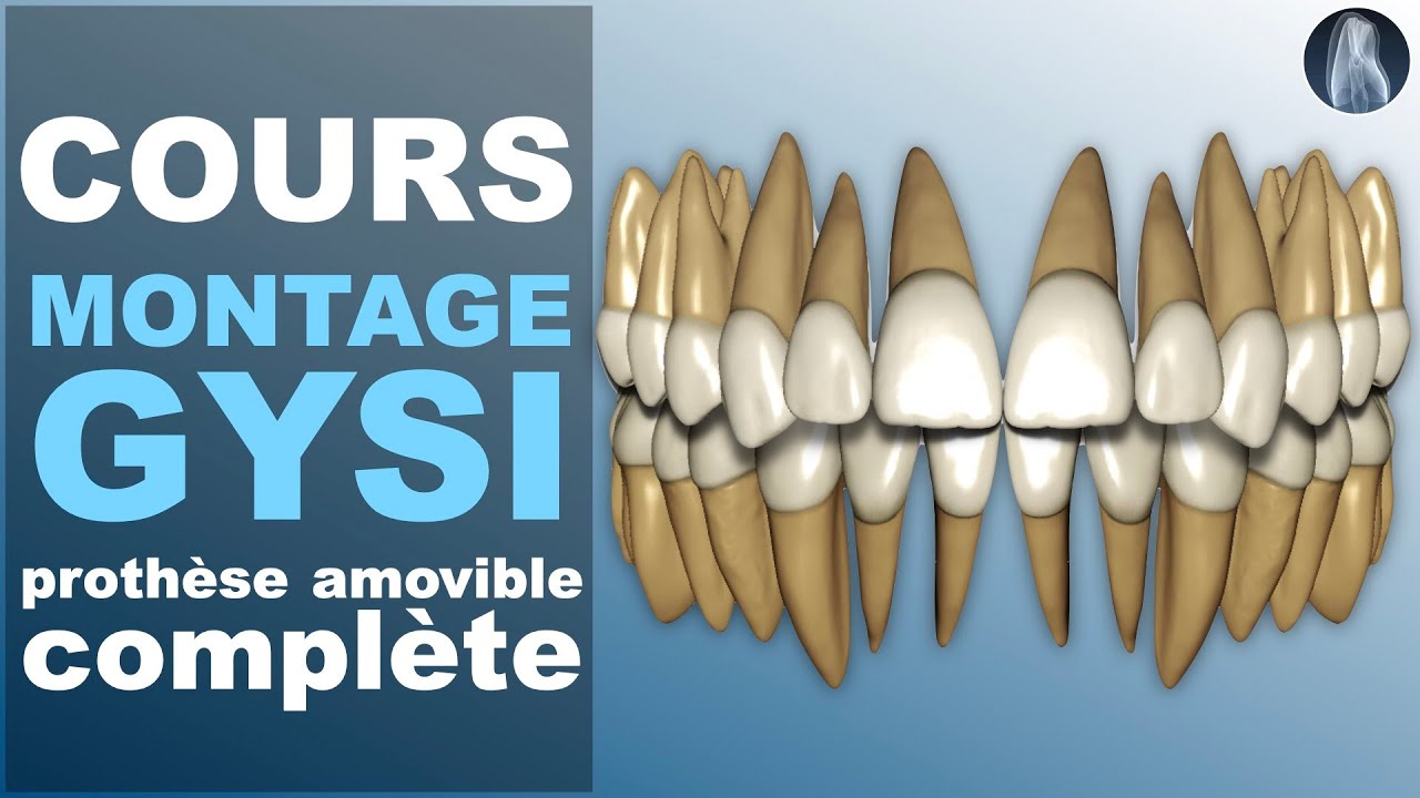 Montage des dents en prothèse complète : Découvrez le protocole GYSI pas à pas ! 🦷