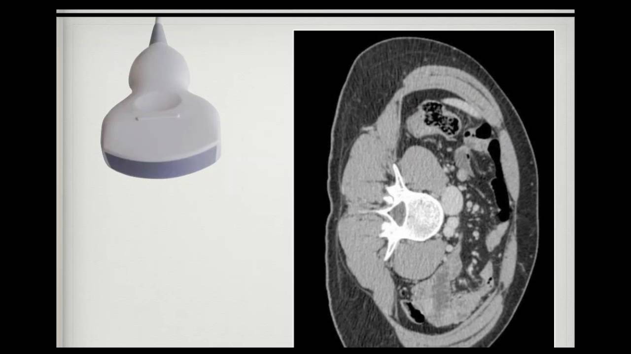 Bloqueo del Plexo Lumbar  Dr  E Moreno SCL