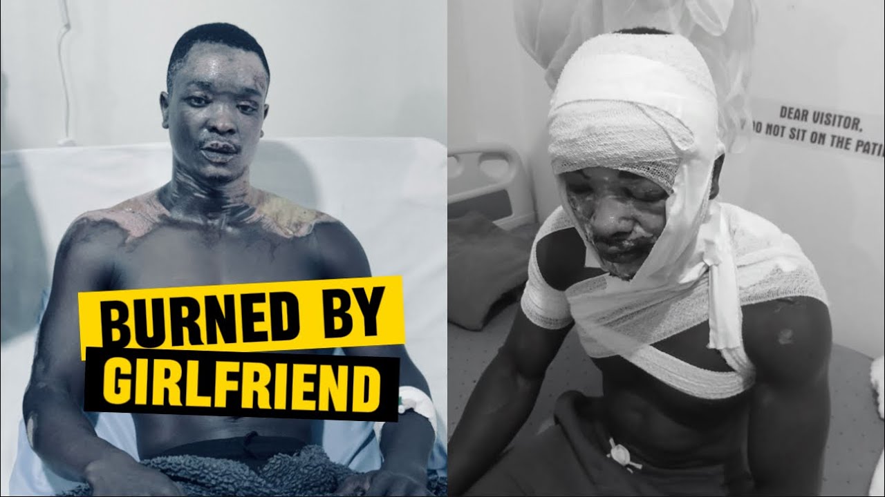 Story of the 27-Year-Old Man Burned by His Girlfriend on Valentine&rsquo;s Day.
